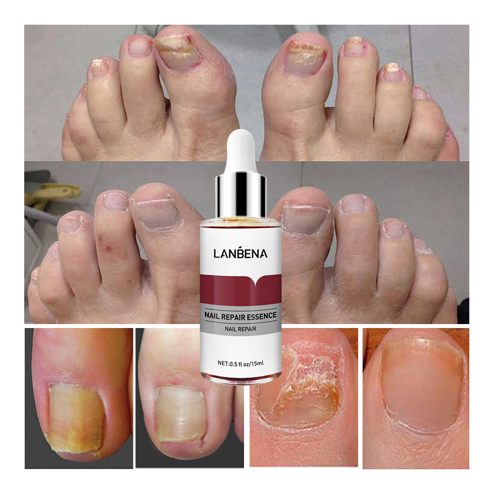 Lanbena Nail Repair Essence Serum 12ml
