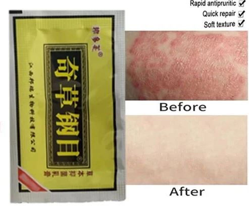 FREE SAMPLE - Natural Chinese Herbal Cream Psoriasis Cream and Eczema Cream