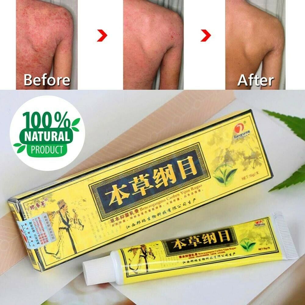 Chinese Herbal Cream - Natural Herbal Psoriasis Cream and Eczema Cream